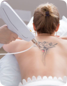 Eliminación de tatuajes