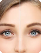 Blefaroplastia no invasiva